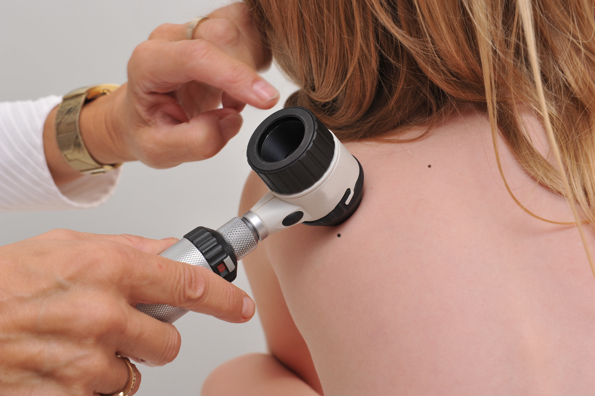 Dermatologija mi je pomagala pri aknah na obrazu